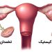 درمان کیست های تخمدانی با قارچ گانودرما