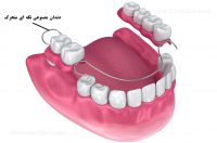 Replacing-missing-teeth1-2