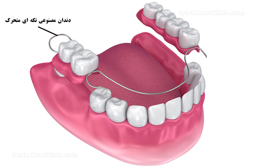 Replacing-missing-teeth1-2