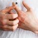 Womens-hand-eczema