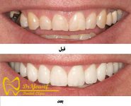 اصلاح طرح لبخند و سفید کردن دندان در یک جلسه