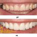اصلاح طرح لبخند و سفید کردن دندان در یک جلسه