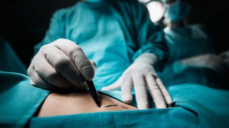 fistula-surgery