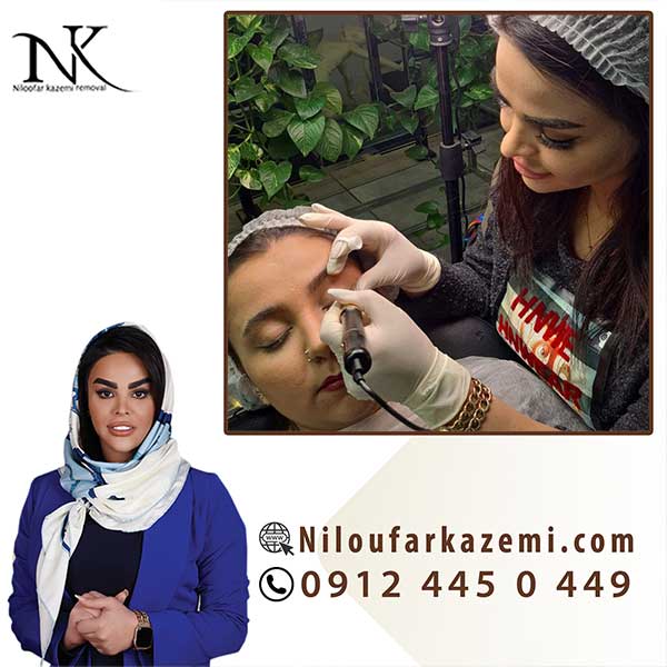 ریموو تاتو خط چشم به صورت پیشرفته و در یک جلسه