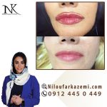 ریموو تاتو خط لب بدون درد و خونریزی با استفاده از بهترین روش ها