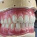 ساخت پروتز دندان مصنوعی رایگان در تهران