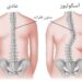 کمربند اصلاحی اسکولیوز – اصلاح اسکولیوز -درمان غیر جراحی اسکولیوز-