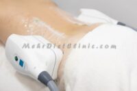 چربی-سوزی-شکم-و-پهلو-با-دستگاه-لاغری-چربی-شکن_copy_780x520
