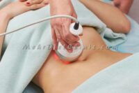 لیفت-شکم-با-دستگاه-لاغری-آر-اف-لیفت-RF