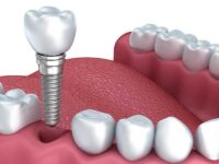 implante-dentário-blog1-800x600