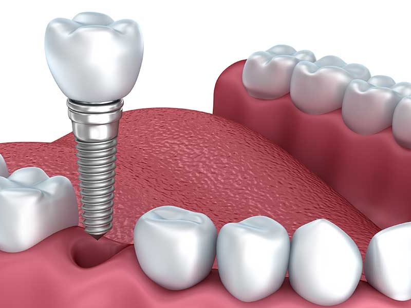 implante-dentário-blog1-800x600